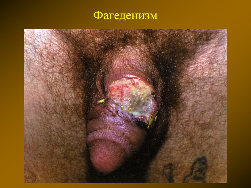 Фагеденизм